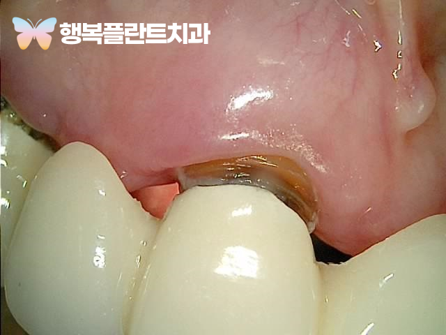 브릿지 내부 치아가 보이는 모습