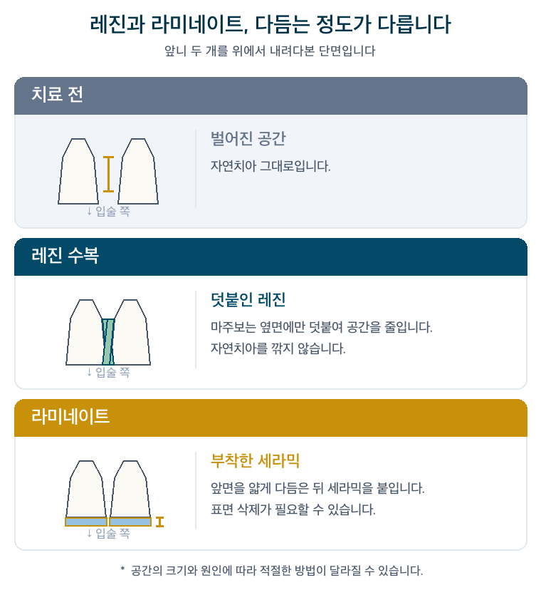 레진과 라미네이트의 자연치아 삭제 정도를 비교한 단면 설명 그림