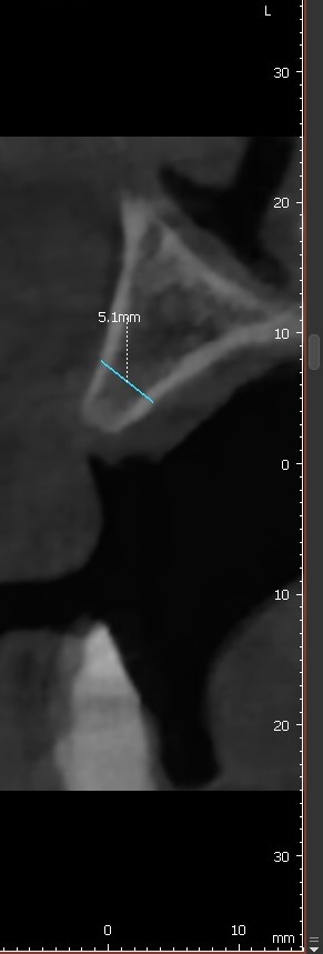 구치부 임플란트 CT 분석