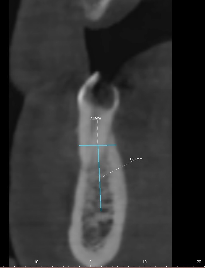 아래턱 어금니 임플란트 CT 식립 계획