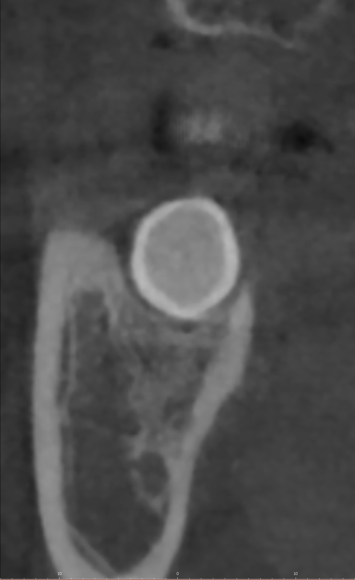 CT 단면